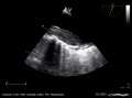 File:Aortic dissection E00249 (CardioNetworks ECHOpedia).webm