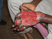Ulceration of the skin over the back of a teenager's hand