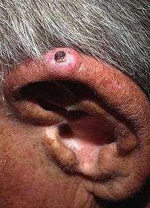 Solitary, pink, dome-shaped papule on the superior helix of an adult