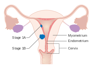 A diagram of stage IA and IB endometrial cancer