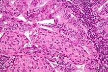 Image of the histology of an endometrioid endometrial adenocarcinoma