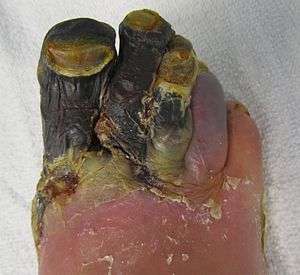Blackened necrosis of multiple toes on an adult foot
