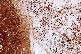 Image of gliosis in tissue