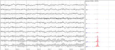 Human EEG with prominent alpha-rhythm