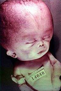 Preserved corpse of a newborn with an enlarged head