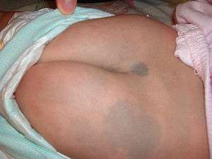 Several light blue patches of skin distributed over a child's lower back and buttock