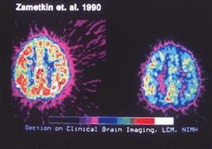 Image of PET brain scan showing decreased neural activity of ADHD subjects compared to control.