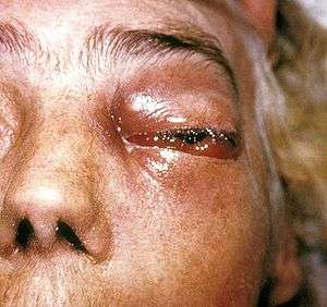 Periorbital fungal infection known as mucormycosis, or phycomycosis PHIL 2831 lores