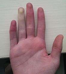 Example of Raynaud's phenomenon, viewed from the front of the hand