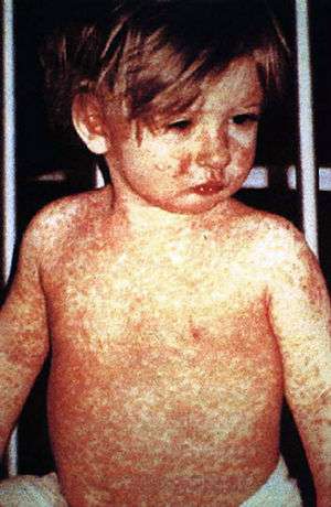 Young child with a red rash covering face, chest, shoulders, and arms
