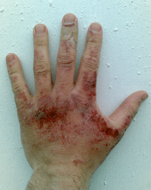 Red erosions, some with crusting, all on the back of an adult hand