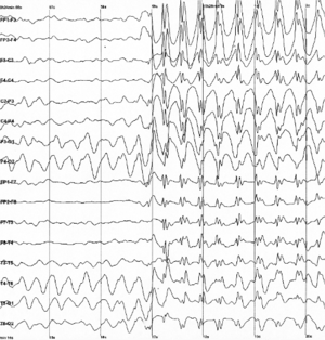 Graph showing 16 voltage traces going across the page from left to right, each showing a different signal. At the middle of the page all of the traces abruptly begin to show sharp jerky spikes, which continue to the end of the plot.