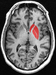 This is a transverse section of the striatum from a structural MR image. The striatum includes the caudate nucleus (top) and putamen (right) and the globus pallidus (left).