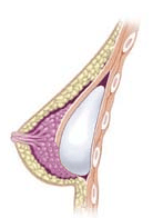 Subpectoral breast implant diagram