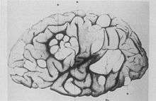 A side profile sketch of a brain, with parts indicated by a letter code. The normal convolutions of the brain are distorted in these areas, forming lumps or thickened folds.