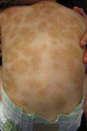 Multiple tan patches scattered over the back of a young child